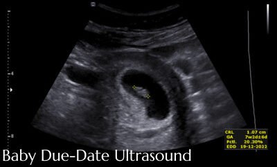 Early pregnancy ultrasound scan with estimated due-date measurements