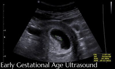 Early pregnancy ultrasound scan with estimated gestational age measurements